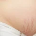 Pregnancy Stretch Marks