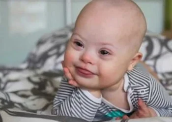 baby with down syndrome