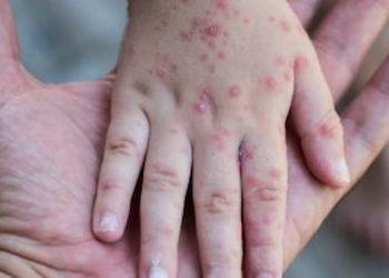 Eczema
