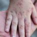 Eczema