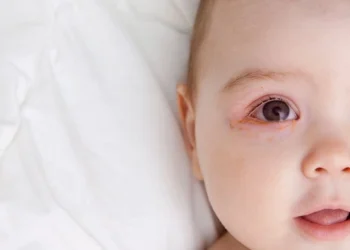 Conjunctivitis