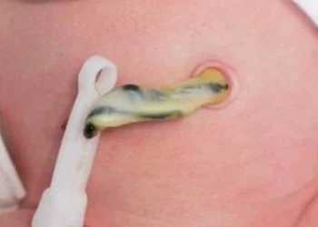 Umbilical Cord Stump