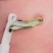 Umbilical Cord Stump