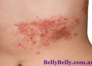 Shingles What Is Shingles