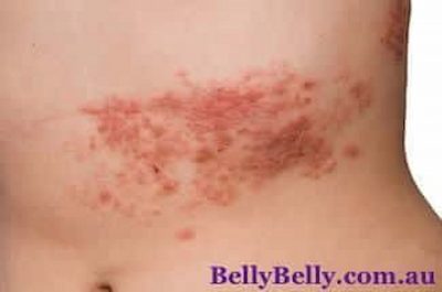 Shingles What Is Shingles