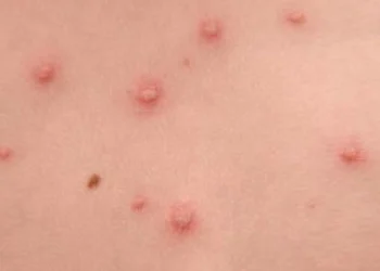 chicken pox