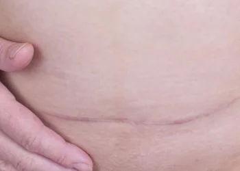 uterine dehiscence