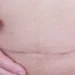 uterine dehiscence