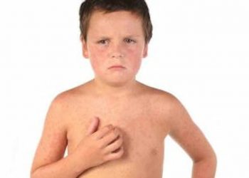 Measles If Your Child Has It Try THIS For A Better Recovery