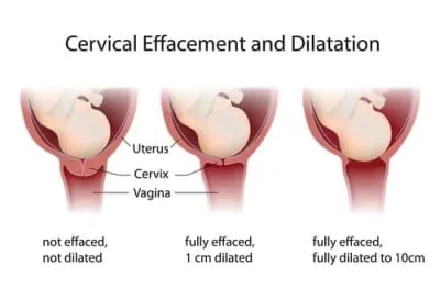 dilation of the cervix