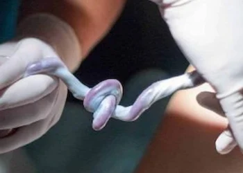 single artery umbilical cord