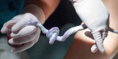 single artery umbilical cord