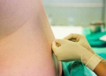 When Can You Get An Epidural During Labour Understanding Epidurals Part