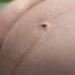 linea nigra