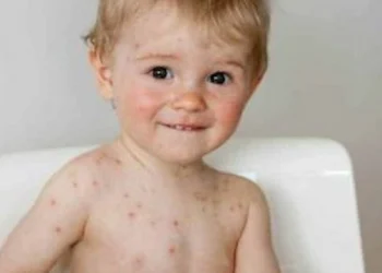 vaccinate for chickenpox