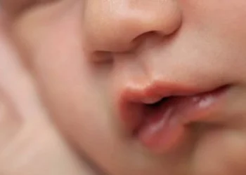 upper lip tie