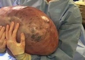 Woman Has Pound Ovarian Cyst Removed After Doctors Ignored Her Pain
