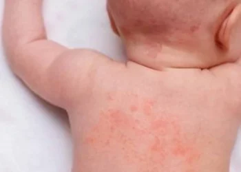 heat rash