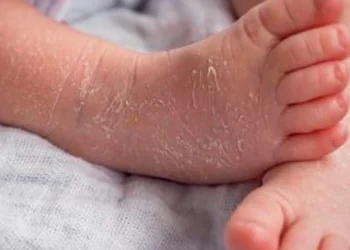 newborn skin peeling