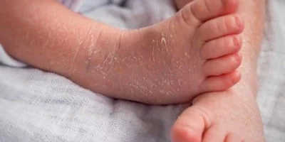 newborn skin peeling