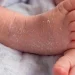 newborn skin peeling
