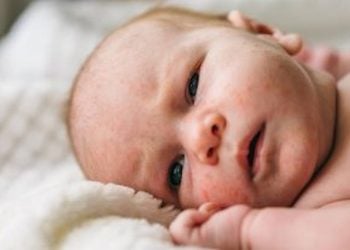 Baby Acne Treatment Causes And How To Get Rid Of It