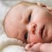Baby Acne Treatment Causes And How To Get Rid Of It