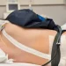epidural side effects