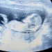 nuchal translucency scan