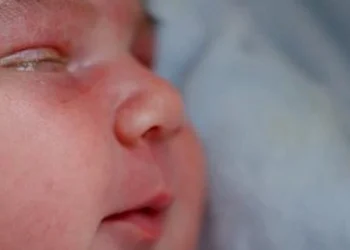 newborn eye discharge