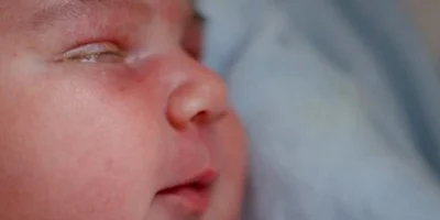 newborn eye discharge