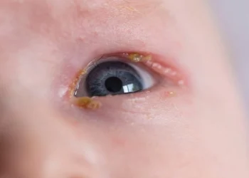 newborn sticky eye