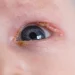 newborn sticky eye