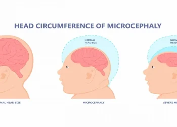 what is microcephaly