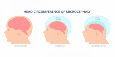 what is microcephaly