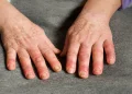 Raynauds Disease And Syndrome