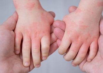 Eczema Symptoms