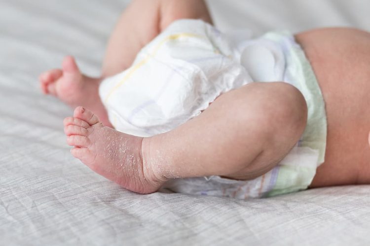 Erythema Toxicum | A Benign Newborn Rash | BellyBelly
